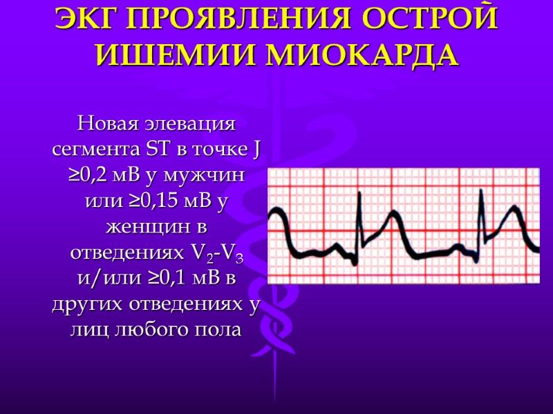 ЭКГ ПРОЯВЛЕНИЯ ОСТРОЙ ИШЕМИИ МИОКАРДА Новая элевация сегмента ST в точке J ≥0,2 мВ